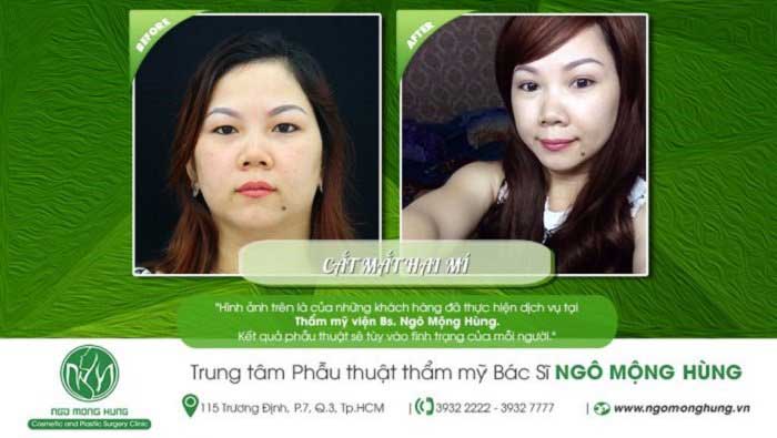 Cắt mí mắt