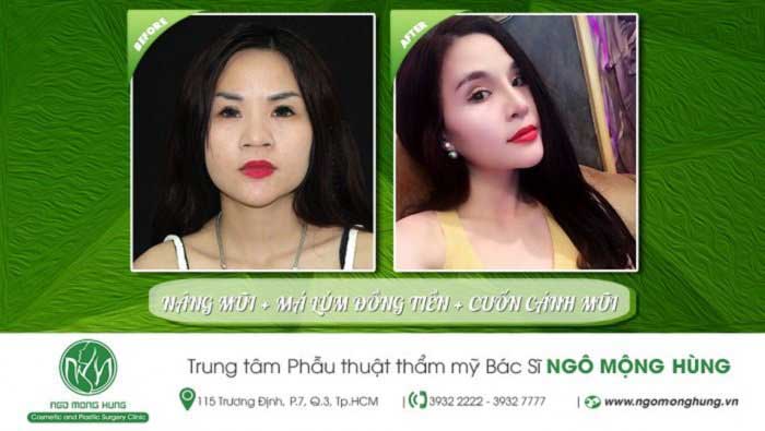 Nâng mũi Hàn Quốc