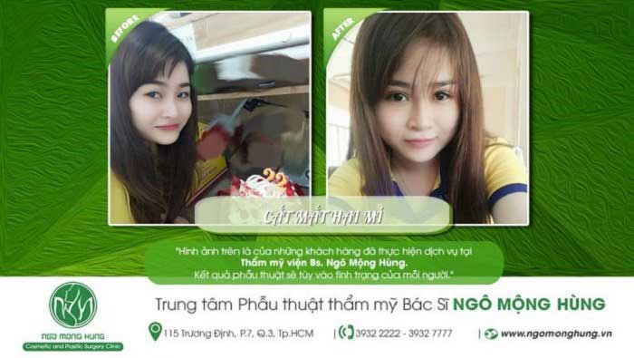 Cắt mí mắt