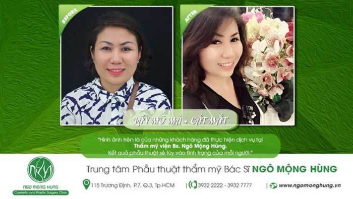 Cắt mí mắt
