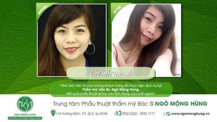 Cắt mí mắt
