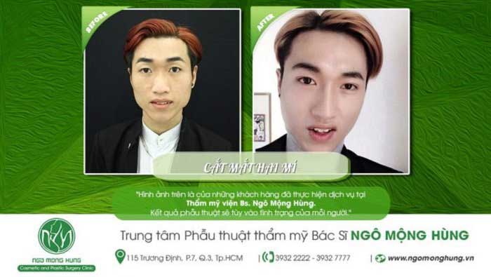 Cắt mí mắt