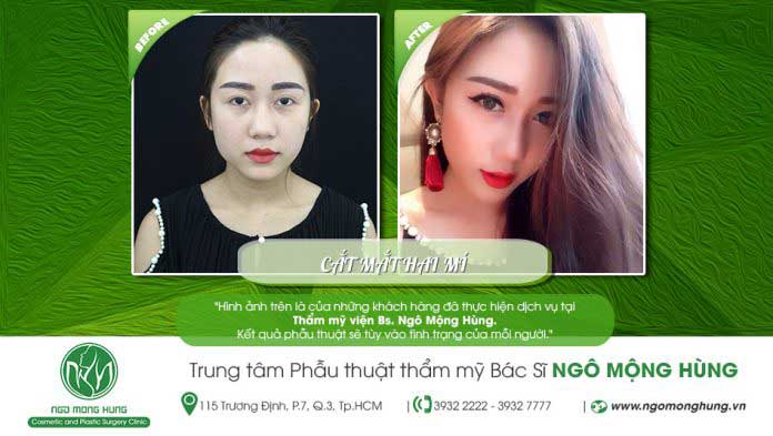 Cắt mí mắt