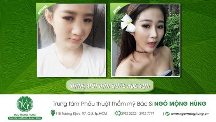 Nâng mũi Hàn Quốc