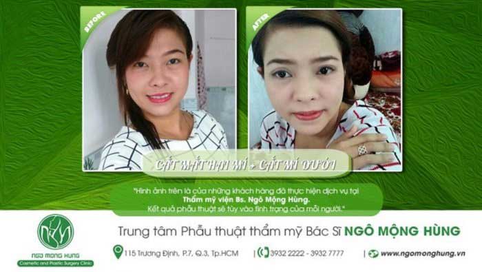 Cắt mí mắt
