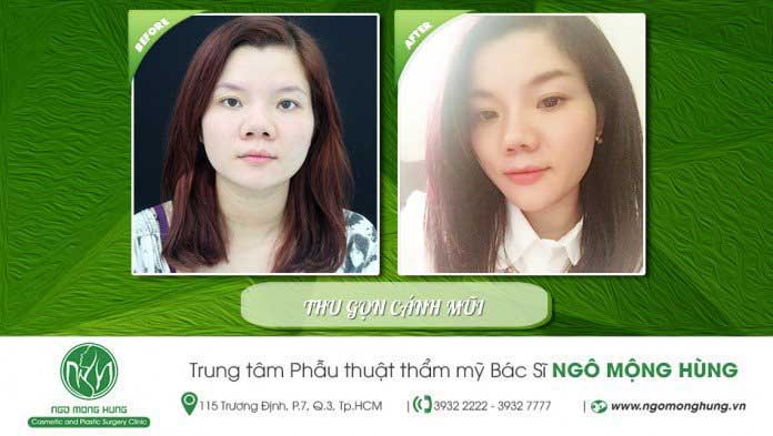 Thu gọn cánh mũi