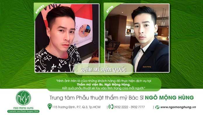 Bấm mí Hàn Quốc