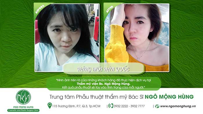 Nâng mũi Hàn Quốc