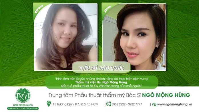 Bấm mí Hàn Quốc