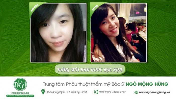Nâng mũi bọc sụn