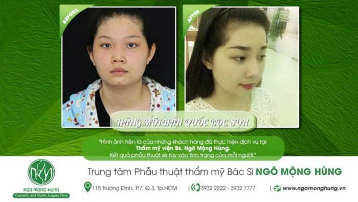 Nâng mũi bọc sụn