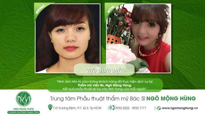 Gọt cằm