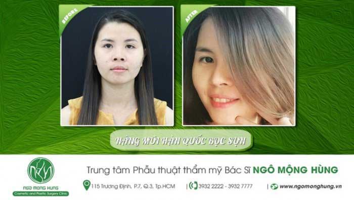 Nâng mũi bọc sụn Nâng mũi bọc sụn