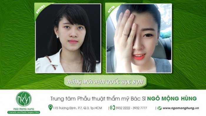 Nâng mũi bọc sụn