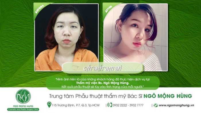 Cắt mí mắt