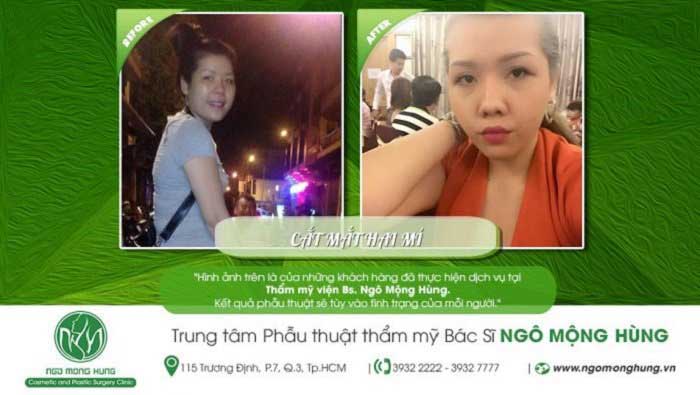 Cắt mí mắt