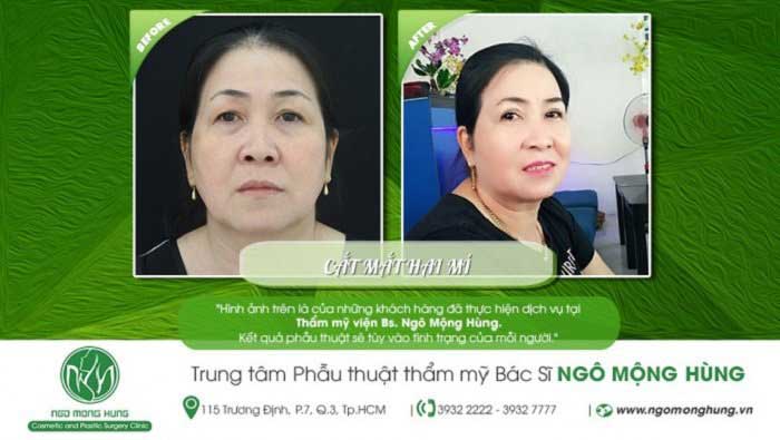 Cắt mí mắt