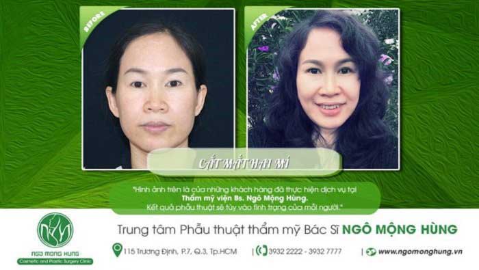 Cắt mí mắt