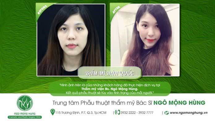 Bấm mí Hàn Quốc