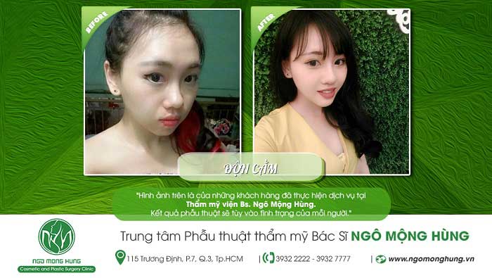 Độn cằm