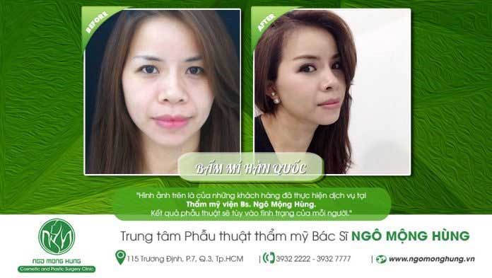 Bấm mí Hàn Quốc