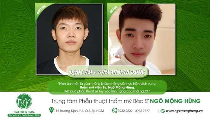 Bấm mí Hàn Quốc Bấm mí Hàn Quốc