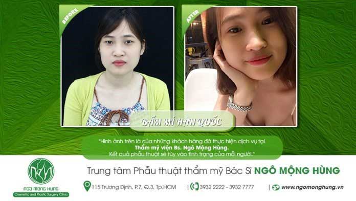 Bấm mí Hàn Quốc
