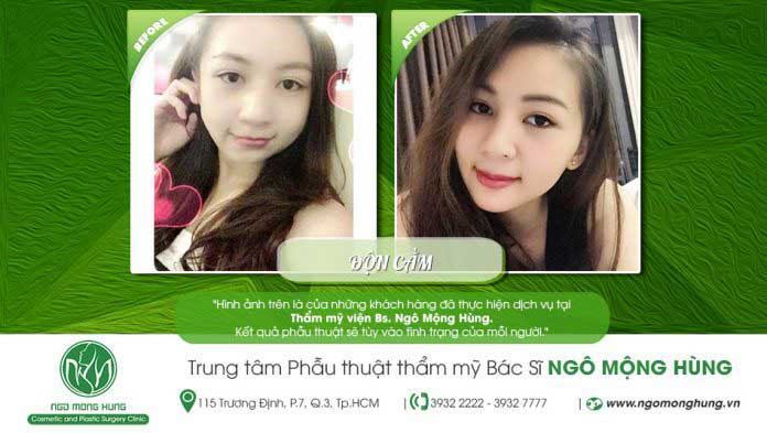 Độn cằm