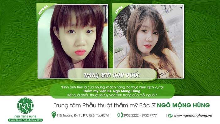 Nâng mũi Hàn Quốc