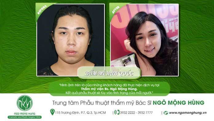 Bấm mí Hàn Quốc