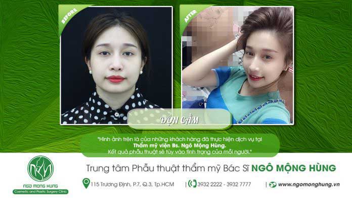 Độn cằm Độn cằm