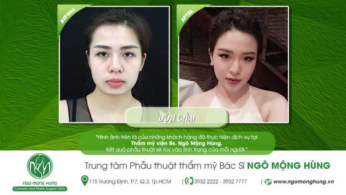 Độn cằm