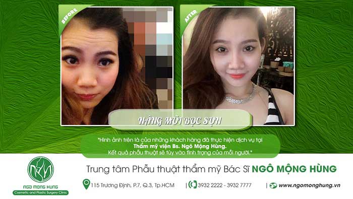 Nâng mũi bọc sụn