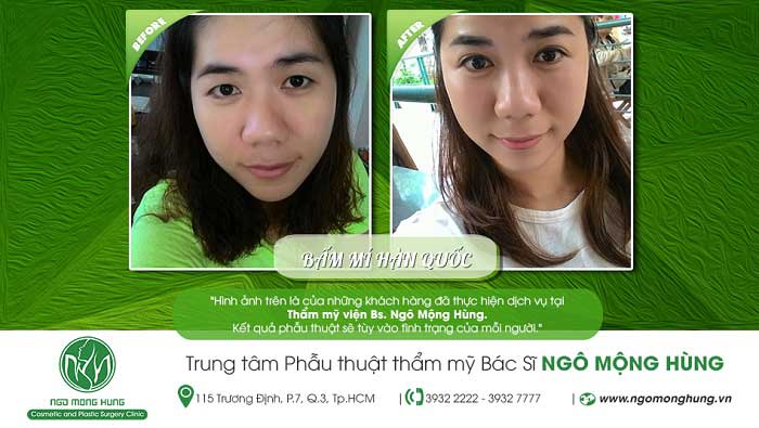 Bấm mí Hàn Quốc