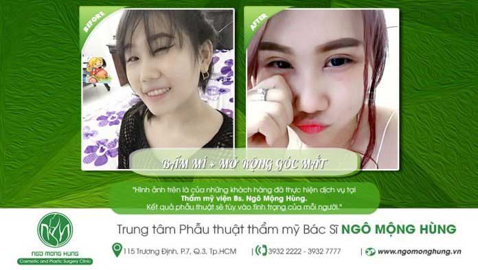 Bấm mí Hàn Quốc