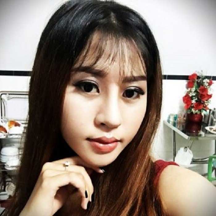 Nâng mũi bọc sụn