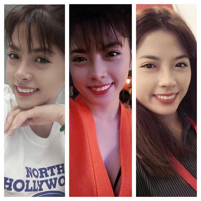 Nâng mũi bọc sụn