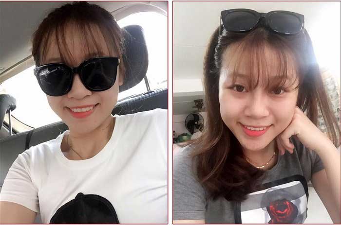 Nâng mũi bọc sụn