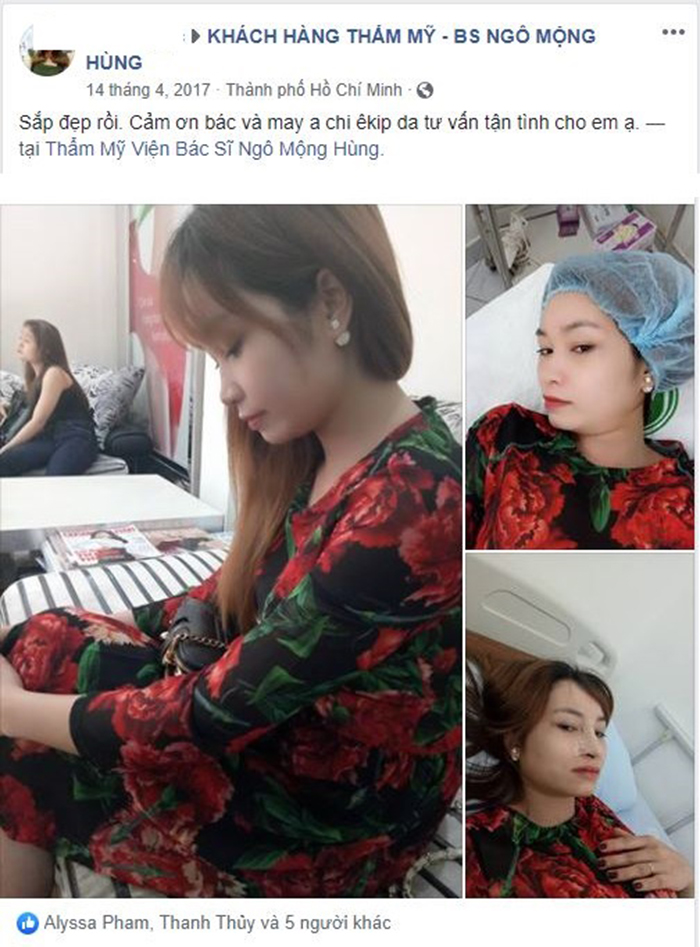 Nâng mũi bọc sụn