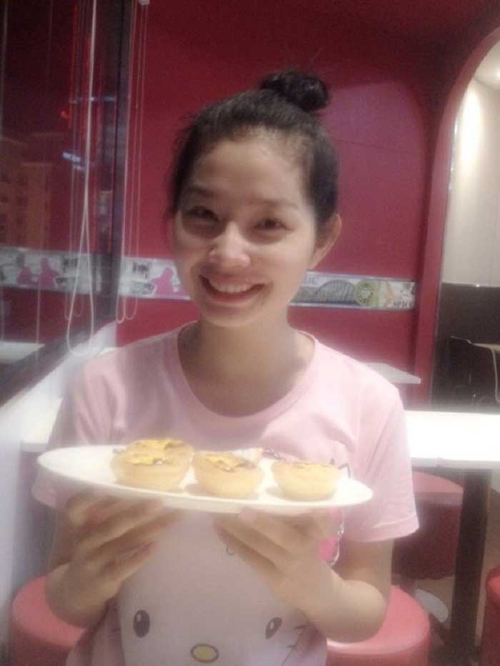Nâng mũi bọc sụn