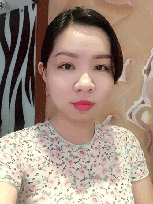 Cắt mí mắt