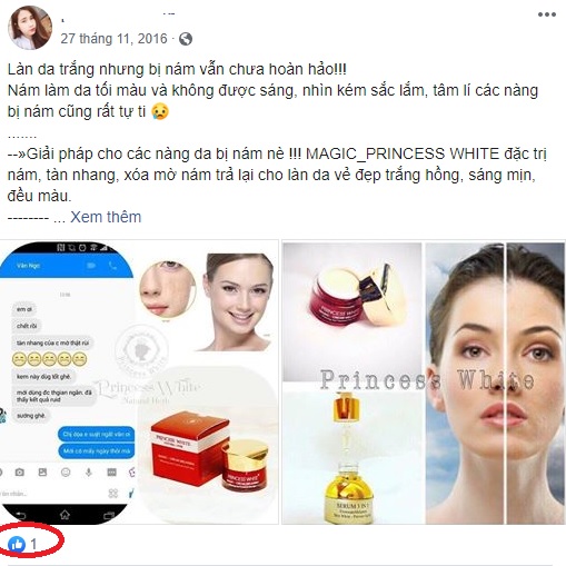 Nâng mũi Hàn Quốc