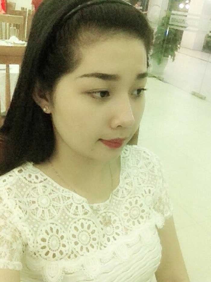 Nâng mũi bọc sụn