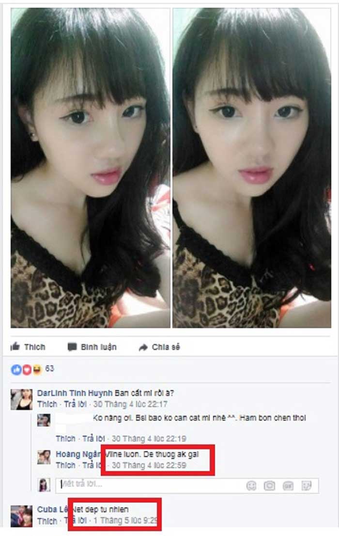 Nâng mũi bọc sụn