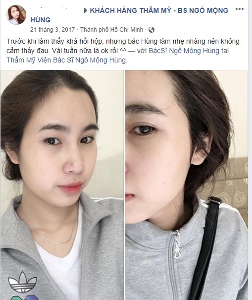 Nâng mũi Hàn Quốc