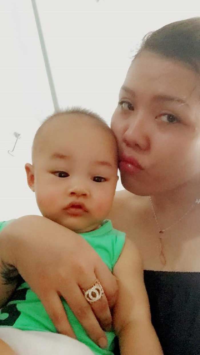 Cắt mí mắt