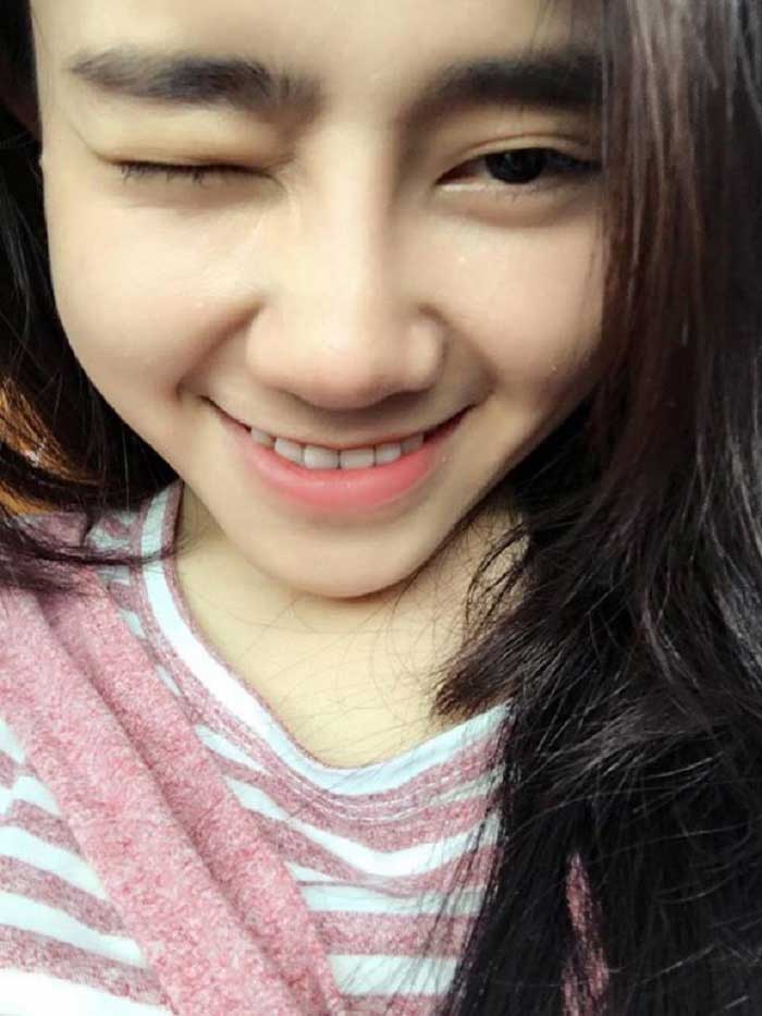 Nâng mũi bọc sụn