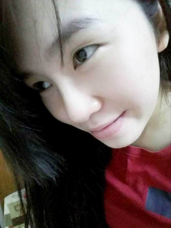 Nâng mũi bọc sụn