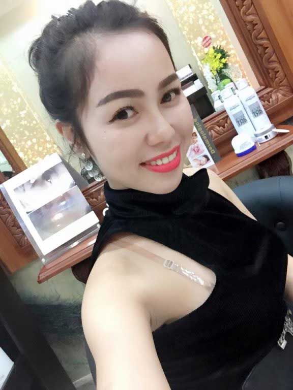 Độn cằm