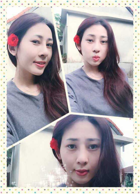 Nâng mũi S Line 